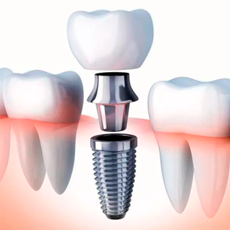 Implantes Dentales